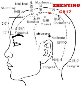 Zhengying GB17 lies on the head, 2.5 cun above the anterior hairline and 2.25 cun lateral to the midline of the head, good for treating mental disorders...